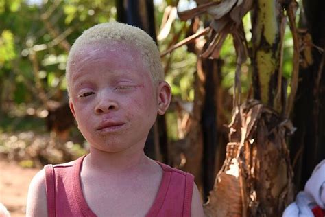 Albino zararları